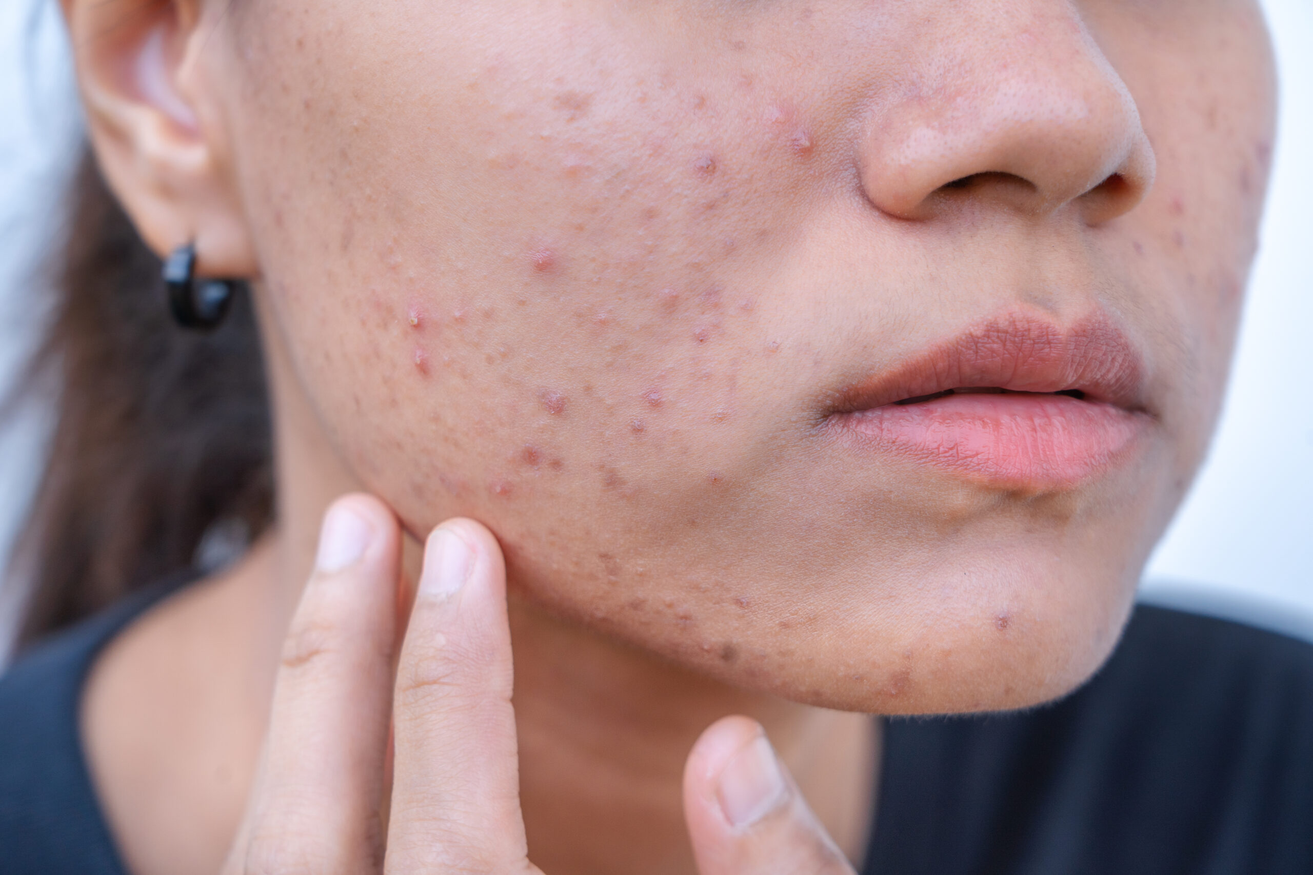 Acne-prone skin