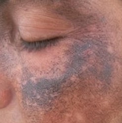 Hyperpigmentation as a result of skin lightening solutions.